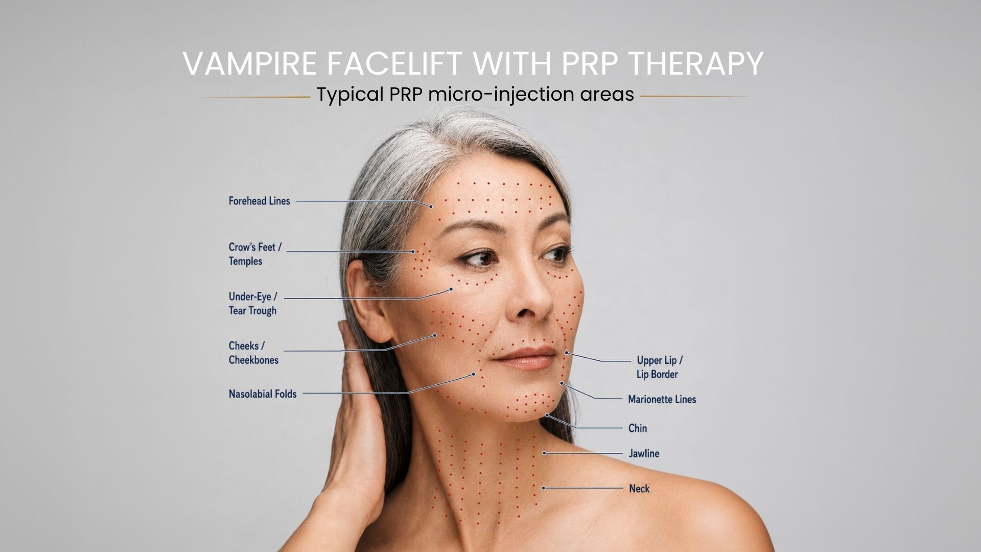 Vampire Facelift with PRP — typical micro-injection areas